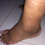 Sprained Ankles YouTube channel thumbnail