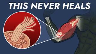 Why your tendons never heal thumbnail